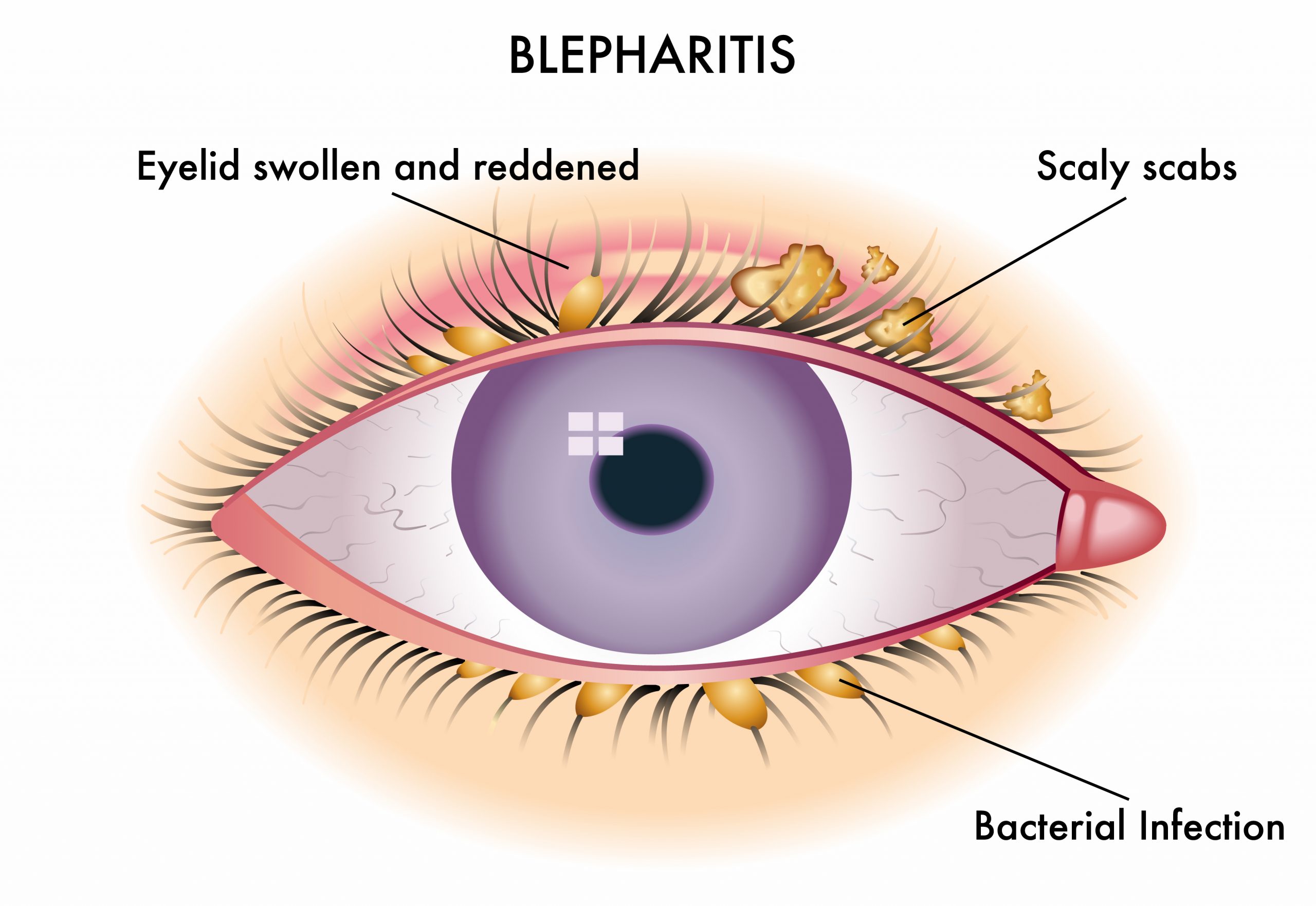 10 Reasons For Having A Swollen Eyelid IrisTech 10 Reasons For Having A Swollen Eyelid IrisTech